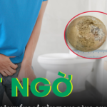 Phát hiện sỏi bàng quang khổng lồ khi bệnh nhân đi khám bệnh khác