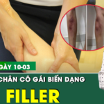 Bản Tin Y Tế 10/3: Tiêm filler để làm thẳng chân, cô gái 29 tuổi biến dạng cẳng chân