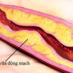 Các yếu tố nguy cơ đột quỵ và cách kiểm soát không dùng thuốc