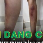 Cô gái 29 tuổi biến dạng hai cẳng chân sau khi tiêm filler làm thẳng chân tại nhà