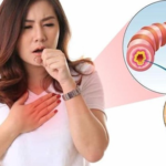 Dùng kháng sinh điều trị viêm phế quản cấp tính: Hiểu đúng để điều trị hiệu quả