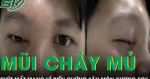 Mũi chảy mủ 4 ngày, nam thanh niên 20 tuổi suýt mất mạng