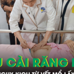 Cứu sản phụ và thai nhi khỏi nguy kịch do nhau cài răng lược trên vết mổ lấy thai cũ