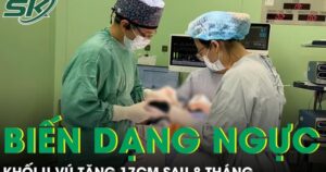 Khối u vú tăng 17cm sau 8 tháng khiến nữ du học sinh biến dạng ngực