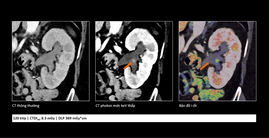Công nghệ cắt lớp vi tính lượng tử: Mở ra cơ hội phát hiện sớm và điều trị chính xác hơn cho người bệnh- Ảnh 3.
