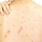 Nguyên nhân mọc mụn trứng cá ở lưng, yếu tố thường gặp nhưng dễ bị bỏ qua