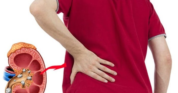 Sỏi thận có gây rối loạn cương dương?