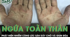Ngứa toàn thân suốt 2 tháng, người đàn ông phát hiện nhiễm cùng lúc sán dây chó và giun đũa