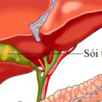 Dấu hiệu cảnh báo sỏi túi mật, nhận biết sớm để tránh biến chứng nguy hiểm