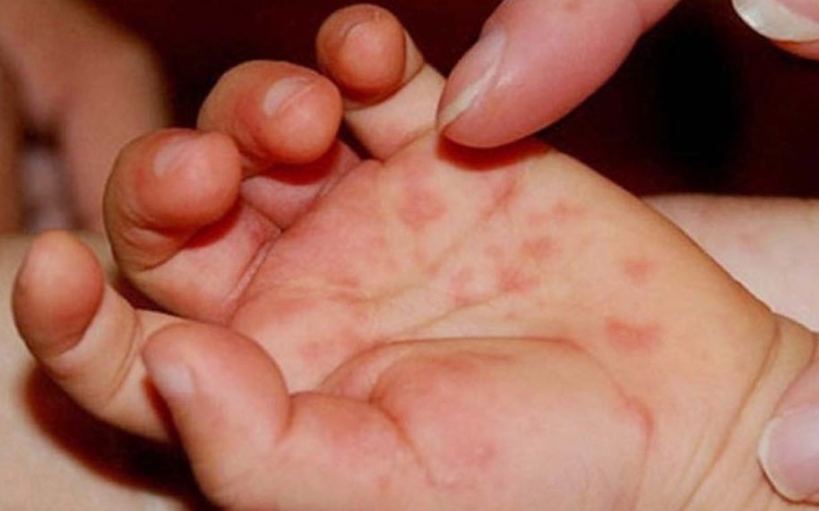 95% ca bệnh tay chân miệng là nhóm trẻ dưới 5 tuổi, Lâm Đồng khẩn trương triển khai ‘3 sạch’ trong trường học- Ảnh 2.