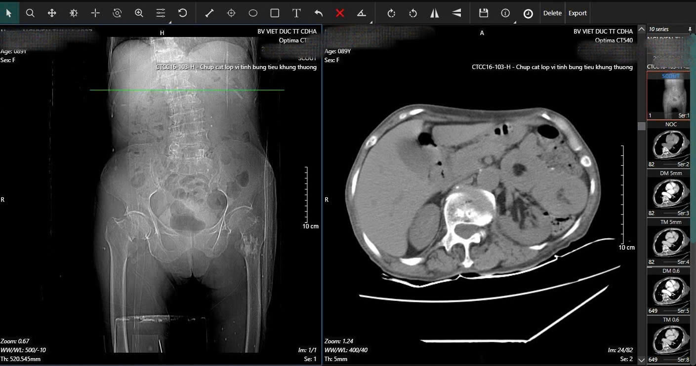 16 ngày, 2 cuộc đại phẫu cứu cụ bà 89 tuổi ở Bệnh viện Việt Đức- Ảnh 1.