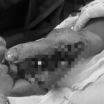 Tai nạn trong tích tắc vì pháo nổ, nam thanh niên suýt mất chức năng bàn tay