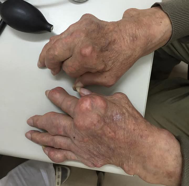 Gout mạn tính gây biến dạng khớp tay, chân xử trí ra sao?- Ảnh 1.