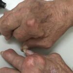 Gout mạn tính gây biến dạng khớp tay, chân xử trí ra sao?