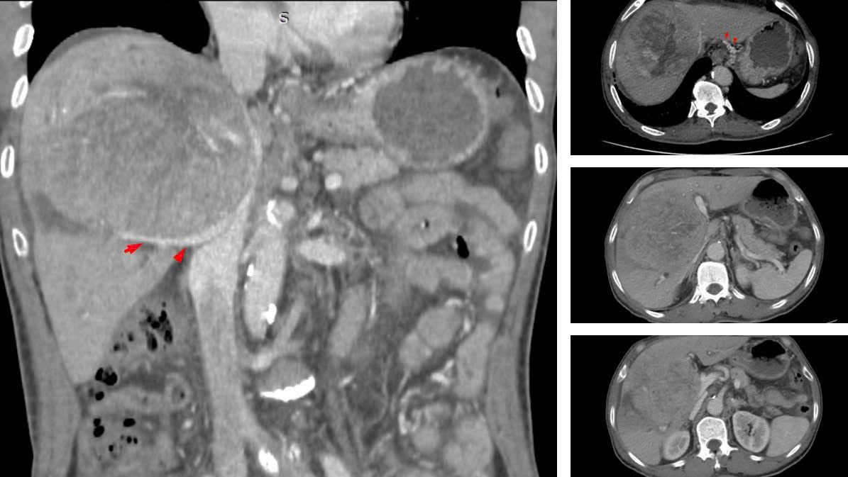 Bệnh nhân ung thư gan tiên lượng sống không quá 9 tháng vẫn kiên cường điều trị sau 3 năm- Ảnh 2.