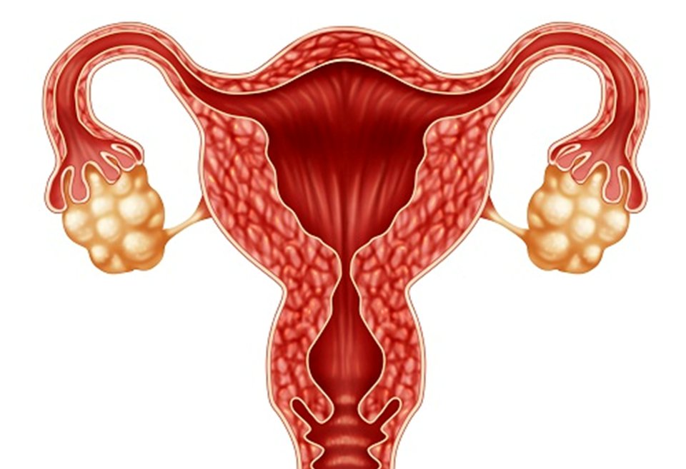 4 cách cải thiện khả năng sinh sản ở phụ nữ mắc Hội chứng buồng trứng đa nang- Ảnh 1.