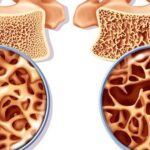 4 bí quyết giúp người lớn tuổi giảm nguy cơ loãng xương