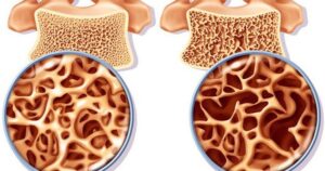 4 bí quyết giúp người lớn tuổi giảm nguy cơ loãng xương