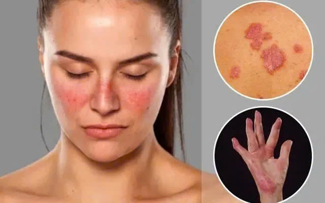 Khi bệnh tự miễn lupus ban đỏ không còn là 'án treo' suốt đời- Ảnh 2.