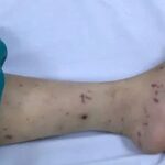 Bé 2 tuổi tử vong do não mô cầu thể tối cấp tại TPHCM