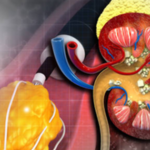 Phát hiện loại thuốc mới đầy hứa hẹn trị bệnh thận hiếm nguy hiểm