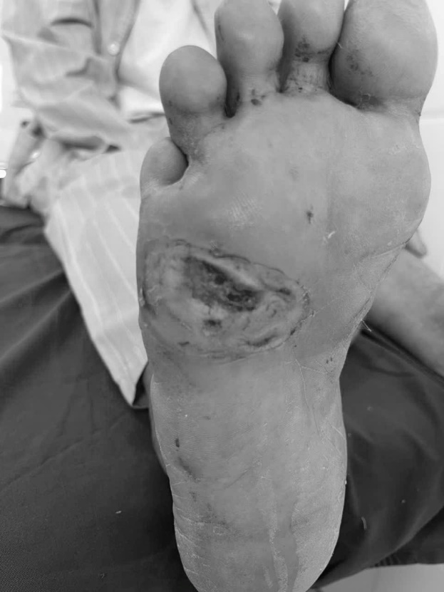 Ứng dụng kỹ thuật cao, Bệnh viện Nội tiết Nghệ An nâng hiệu quả điều trị loét bàn chân- Ảnh 6.