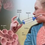 Triệu chứng thường gặp và các mức độ khó thở ở hen suyễn