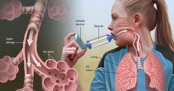 Triệu chứng thường gặp và các mức độ khó thở ở hen suyễn