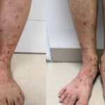 Viêm da do bọ chét: Dấu hiệu nhận biết sớm và cách xử lý tránh nhiễm trùng