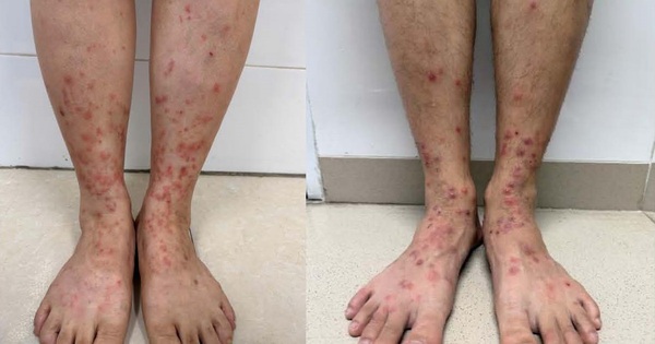 Viêm da do bọ chét: Dấu hiệu nhận biết sớm và cách xử lý tránh nhiễm trùng