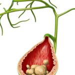 Vì sao sỏi mật hay tái phát và cách phòng ngừa hiệu quả