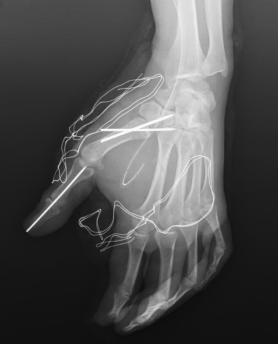 Tai nạn trong tích tắc vì pháo nổ, nam thanh niên suýt mất chức năng bàn tay- Ảnh 1.