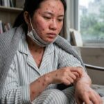 Cách điều trị bệnh thủy đậu tại nhà, ngăn ngừa sẹo