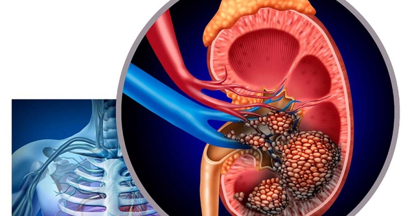 Đau vùng hông lưng, người phụ nữ phát hiện khối u thận