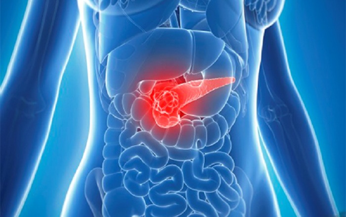 Triệu chứng cảnh báo ung thư tụy