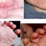 95% ca bệnh tay chân miệng là nhóm trẻ dưới 5 tuổi, Lâm Đồng khẩn trương triển khai ‘3 sạch’ trong trường học