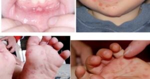 95% ca bệnh tay chân miệng là nhóm trẻ dưới 5 tuổi, Lâm Đồng khẩn trương triển khai ‘3 sạch’ trong trường học