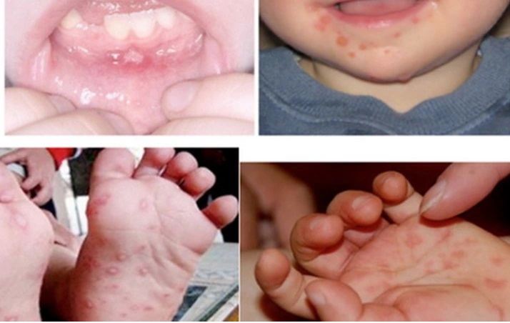 95% ca bệnh tay chân miệng là nhóm trẻ dưới 5 tuổi, Lâm Đồng khẩn trương triển khai ‘3 sạch’ trong trường học- Ảnh 1.