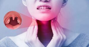 Tại sao viêm họng hạt dễ tái phát?