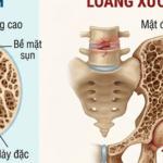 Phòng loãng xương cần hạn chế 5 loại thực phẩm này