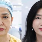 Căng da mặt – khi trẻ hóa không còn là ‘kéo da’ đơn thuần