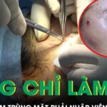 Căng chỉ làm đẹp tại spa cô gái trẻ nhiễm trùng mặt phải nhập viện gắp dị vật