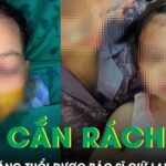 Xót xa bé gái 22 tháng tuổi bị chó cắn rách mặt