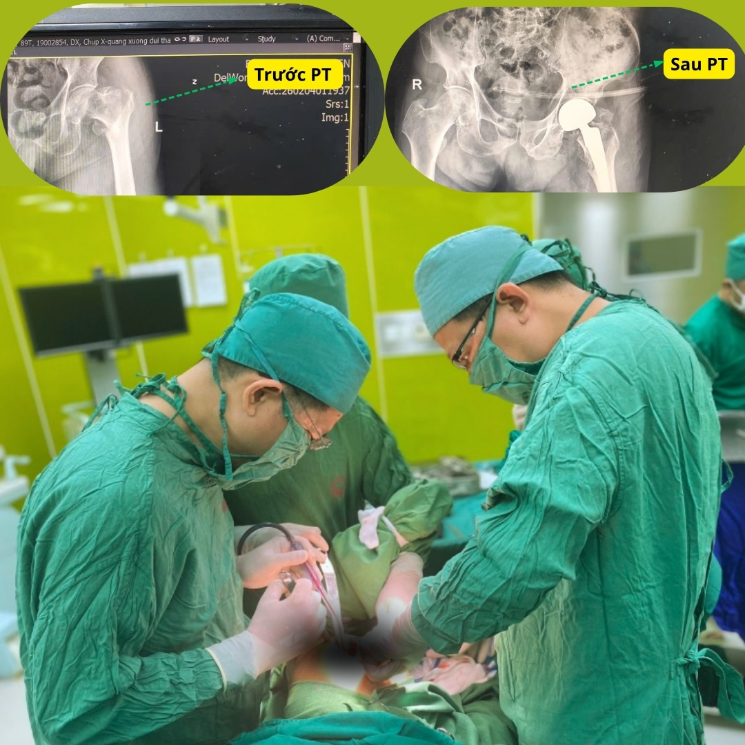 Thay khớp háng bán phần, cụ ông thoát đau và phục hồi nhanh- Ảnh 1. Thay khớp háng bán phần, cụ ông thoát đau và phục hồi nhanh- Ảnh 1.
