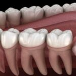 Những biến chứng thường gặp khi mọc răng khôn không thể xem nhẹ