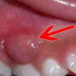 Cảnh báo biến chứng nguy hiểm của áp xe răng