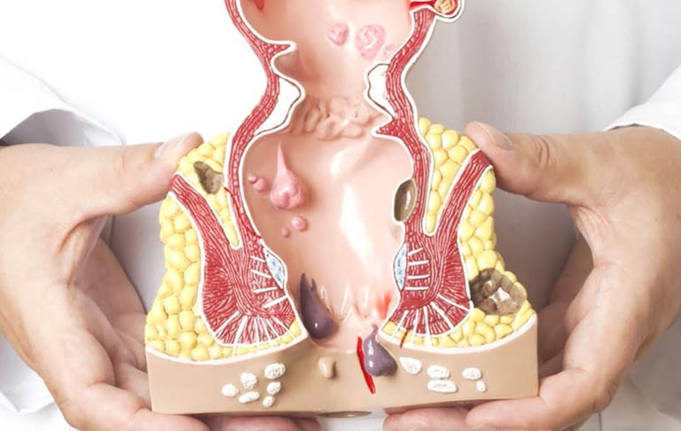 Bệnh trĩ ngoại có gây biến chứng không?- Ảnh 2. Bệnh trĩ ngoại có gây biến chứng không?- Ảnh 2.