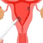 Hội chứng buồng trứng chuyển hóa đa nội tiết – tên gọi mới của hội chứng buồng trứng đa nang