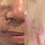 Vì sao ‘mổ đi mổ lại’ vẫn không hết ung thư da?