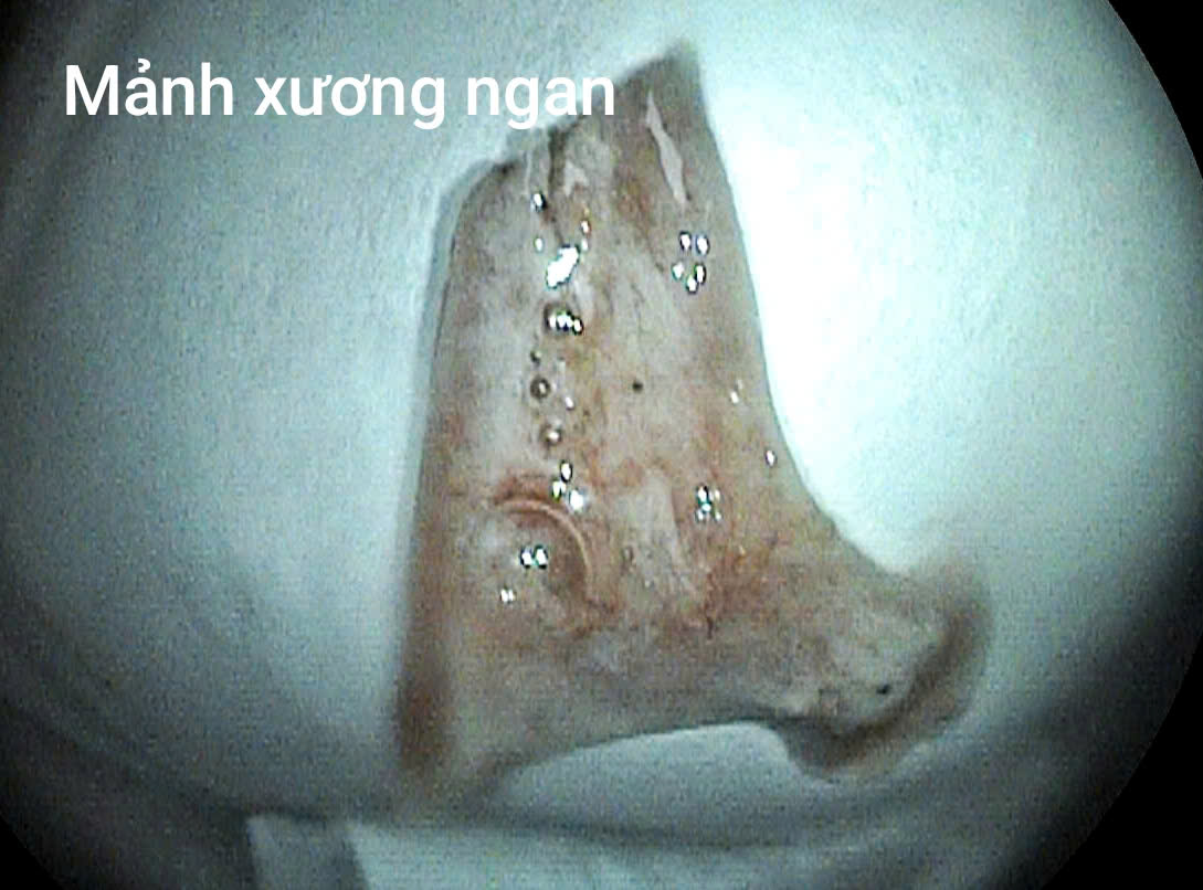 Người đàn ông cấp cứu sau bữa ngan luộc- Ảnh 2. Người đàn ông cấp cứu sau bữa ngan luộc- Ảnh 2.